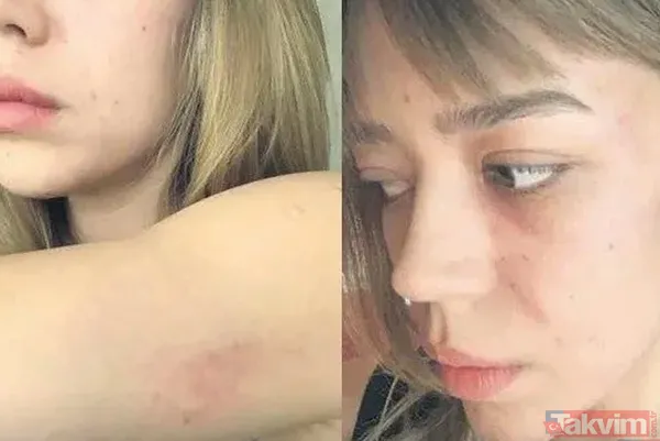 Hatta Darp Edildikten Sonraki Fotoğrafları Ortaya Çıkan Aktan'ın Vücudundaki Morluklar Dikkat Çekti.