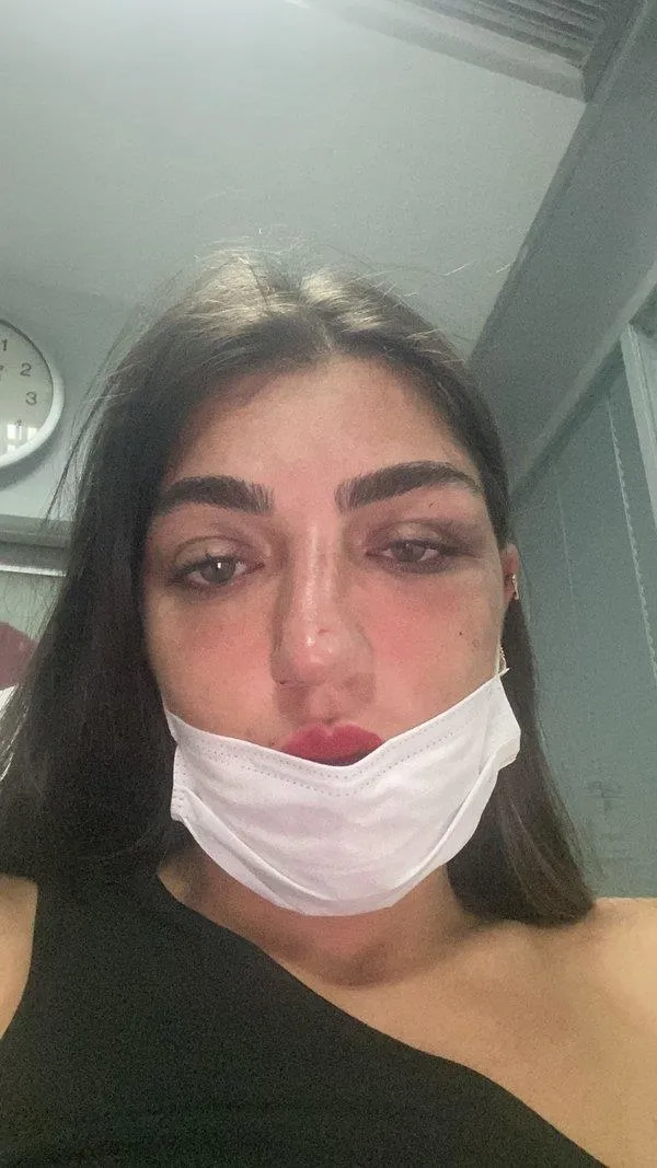 Manken Gizem Akbaş'ın burnunu kıran eski sevgiliye tahliye: Ölmek istemiyorum-6