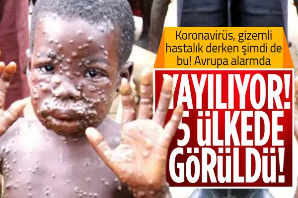 Dünya alarmda! 5 ülkede görüldü! Maymun çiçeği salgını Avrupa'yı vurdu! Maymun çiçeği hastalığı nedir, nasıl bulaşır, tedavisi var mı?-1