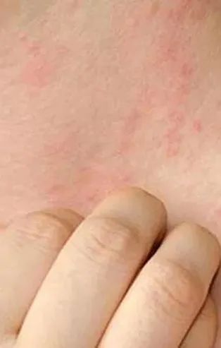 İlaç alerjisine dikkat | 19 Şubat 2022 sağlık haberleri