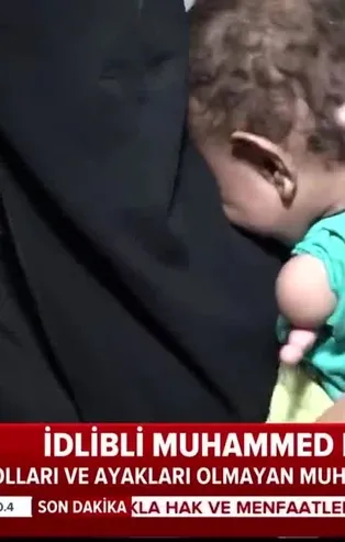Dünyanın konuştuğu İdlibli Muhammed bebek Türkiye'de tedavi ediliyor