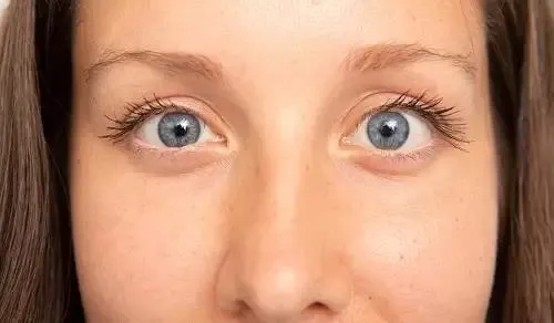 saslik-aileden-miras-1663875675614.jpeg Şaşılık aileden miras! Bu belirtilere dikkat edin...-3