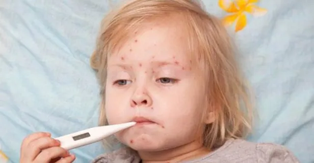 Çocuk Cerrahisi Uzmanı uyardı! Kızamığı erkenden önleyin...