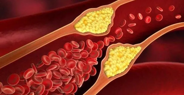 6 adımda kolesterolü düşürün