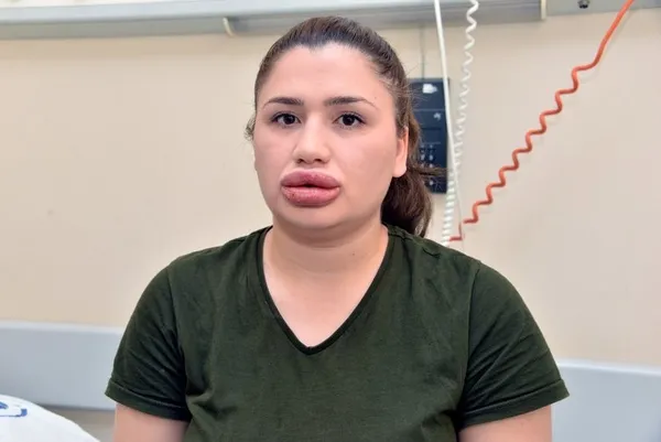 Merve'nin doktoru: Kalıcı dolgu vakası dünyada görülmemiştir-1