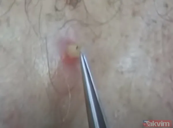 Karnındaki şişlik için gitti içinden çıkan doktorları bile şoke etti! Yer uzak değil Kayseri! 64 kilo girdi 55 kilo çıktı - 33