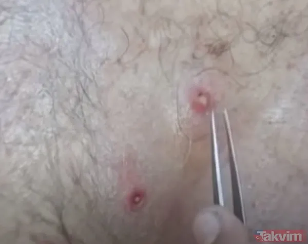 Karnındaki şişlik için gitti içinden çıkan doktorları bile şoke etti! Yer uzak değil Kayseri! 64 kilo girdi 55 kilo çıktı - 25