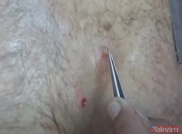 Karnındaki şişlik için gitti içinden çıkan doktorları bile şoke etti! Yer uzak değil Kayseri! 64 kilo girdi 55 kilo çıktı - 31