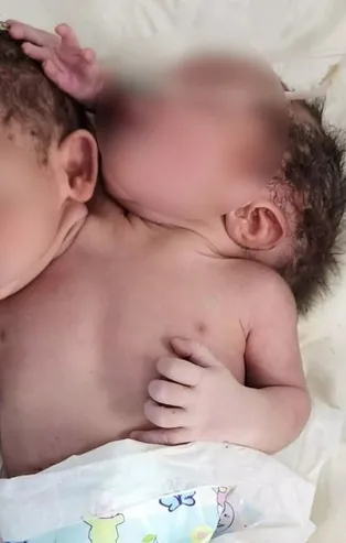 Doktorlar gözlerine inanamadı! Çift başlı üç elli bebek doğdu