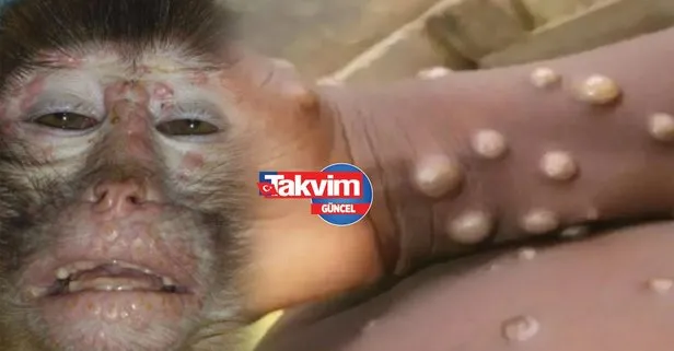 Maymun çiçeği virüsü nedir? Maymun çiçeği virüsü nasıl bulaşır?