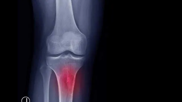 sislik-deyip-gecmeyin-kemik-tumoru-habercisi-olabilir-1674001189259.jpeg Şişlik deyip geçmeyin! Kemik tümörü habercisi olabilir-2