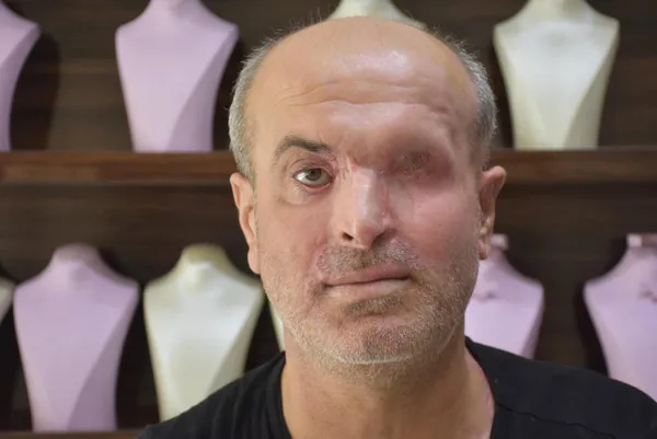 izmir-bucada-30-yillik-kuyumcu-kezzpli-saldiri-sonucu-sol-gozunu-kaybetti-1631280891859.jpg İzmir Buca'da 30 yıllık kuyumcu kezzaplı saldırı sonucu sol gözünü kaybetti-4