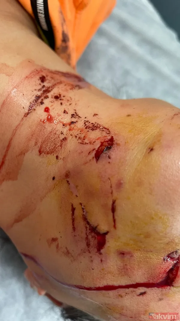 Tuğba Altıntop köpek saldırısına uğradı! Yüzüne dikiş atılan Tuğba Altıntop'un son hali yürek sızlattı - 11