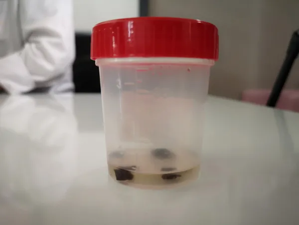 kanser-suphesiyle-doktor-doktor-gezdi-akcigerinden-32-yil-sonra-cam-fistigi-cikarildi-1610781617620.jpg Kanser şüphesiyle doktor doktor gezdi! Akciğerinden 32 yıl sonra çam fıstığı çıkarıldı-4