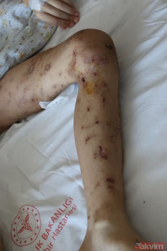 Ankara'da sokak köpeklerinin saldırısının ardından 9 ameliyat geçiren Enes Koca, yeniden yürümeye hazırlanıyor - 10