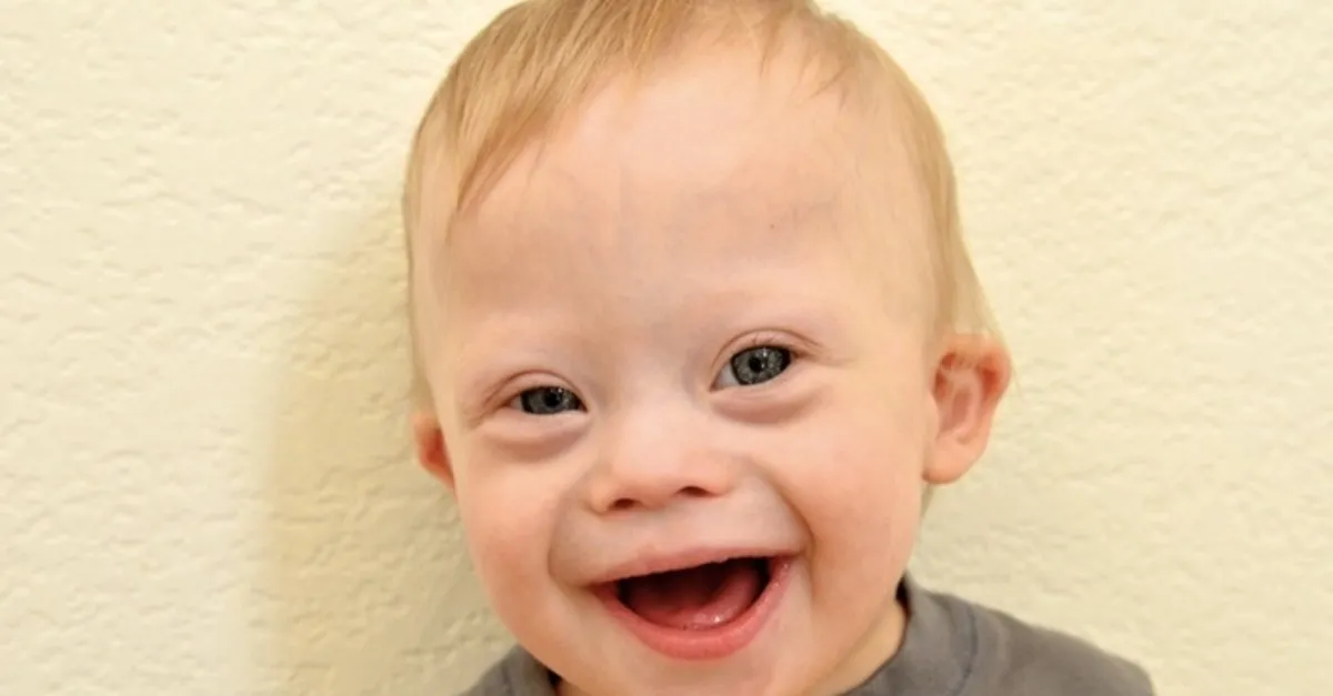 Down Sendromu Nedir Neden Olur Tedavisi Var Mi Down Sendromu Kromozom Farki Nasil Anlasilir Takvim