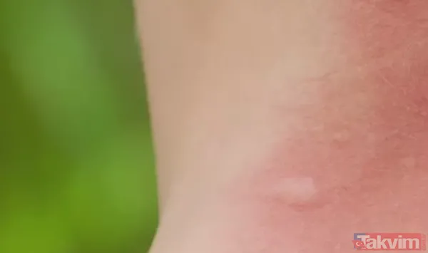 Sivri sinek ısırığından sonra cilt kabarmalarına ve kaşıntılarına iyi gelecektir...