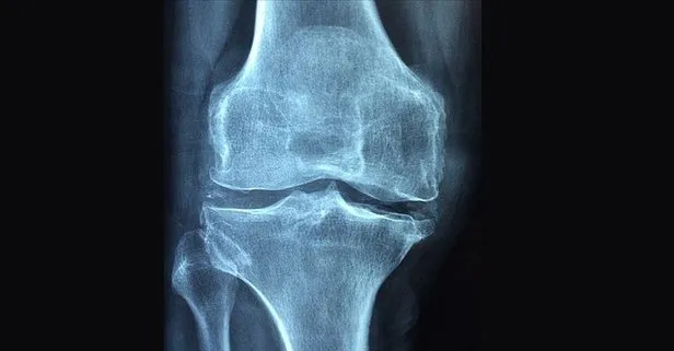 Uzmanı kemik erimesi Osteoporoz hakkında tanı ve tedavi yöntemlerini açıkladı