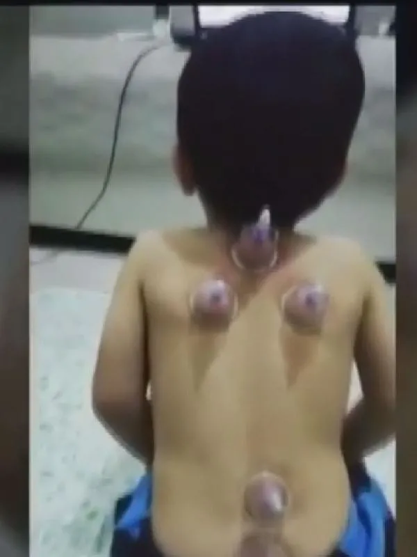 Sosyal medyadaki hacamat görüntüleri olay yarattı: Bebeklere bile yaptılar! Uzmanlardan kritik uyarı-4
