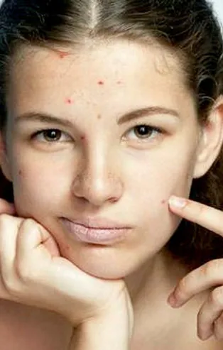 Rüyada yüzünde sivilce görmek neye işarettir, ne anlama gelir? Rüyada sivilce patlatmak hayırlı mıdır?