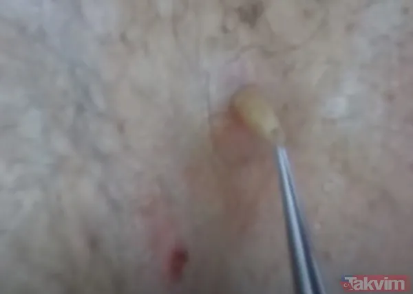 Karnındaki şişlik için gitti içinden çıkan doktorları bile şoke etti! Yer uzak değil Kayseri! 64 kilo girdi 55 kilo çıktı - 42