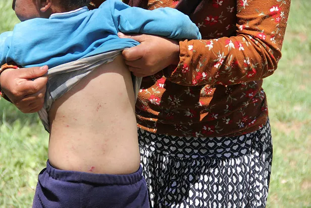 1591603257315.jpg Sivas'ta ormanlık alanları istila eden tırtıllar yüzünden günde 10 kişi hastaneye gidiyor!-3