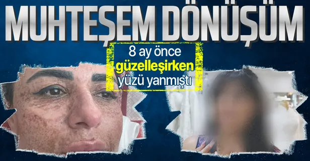 8 ay önce güzellik merkezinde yüzü yanan kadın tedavi sonrası artık aynaya bakabiliyor