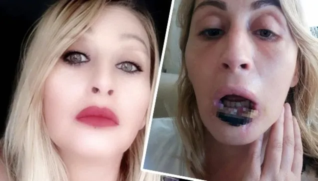 Daha Guzel Olmak Ugruna Estetik Yaptirdi Dudagi Dustu Videosunu Izle Takvim Tv