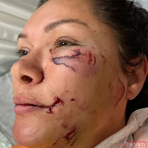 Tuğba Altıntop köpek saldırısına uğradı! Yüzüne dikiş atılan Tuğba Altıntop'un son hali yürek sızlattı - 13