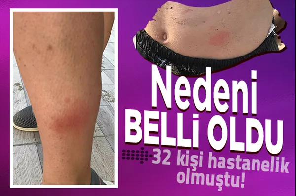 Sakarya Karasu'da denize giren 32 kişi hastanelik olmuştu! Vücutlarındaki kızarıklığın nedeni belli oldu-1