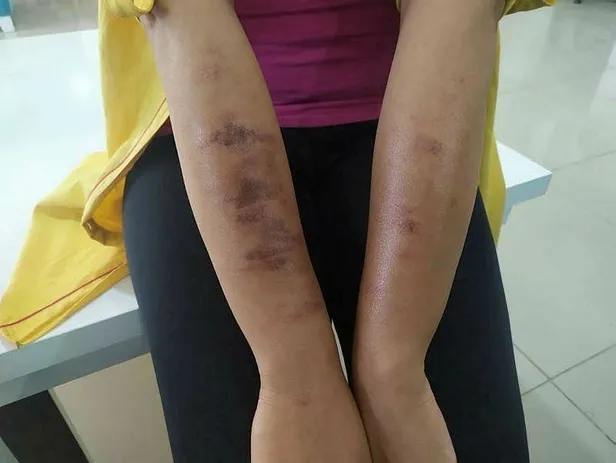 Son dakika: Bir güzellik merkezi skandalı daha: Lazer genç kadının vücudunu yaktı-2