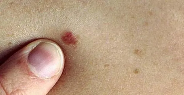 Benlere dikkat! Kanser riski kapıda