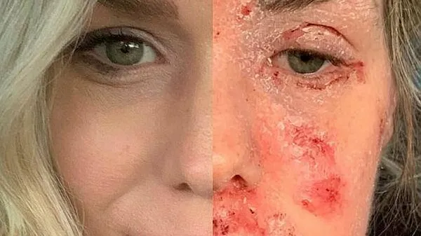 Güney Afrika’da yaşayan Samantha Saunders'ın hayatı bir krem ile değişti! Sebebini öğrenenler şoke oldu-6