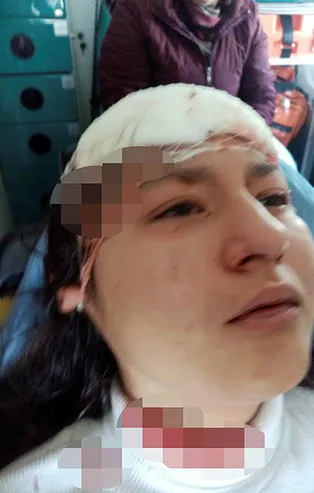 2. Asiye Ateş vakası! Kastamonu'da sokak köpekleri selfie yapan genç kızın yüzünü parçaladı