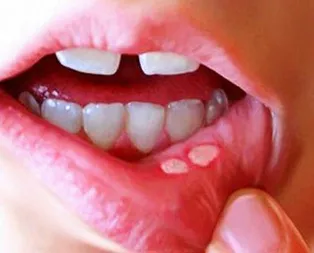 Aft çıkarsa yapmanız gerekenler!