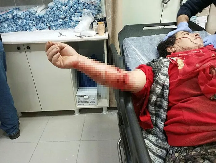 yine-kopek-saldirisi-dogo-argentino-cinsi-kopegin-saldirdigi-kadin-hastaneye-kaldirildi-1703595168880.jpeg Yine köpek saldırısı! Dogo Argentino cinsi köpeğin saldırdığı kadın hastaneye kaldırıldı-2