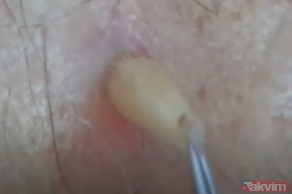 Karnındaki şişlik için gitti içinden çıkan doktorları bile şoke etti! Yer uzak değil Kayseri! 64 kilo girdi 55 kilo çıktı - 39