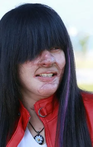 Yüzüne asit döken erkek arkadaşını affeden Berfin Özek'ten flaş paylaşım “Bunu nasıl yapabildim”