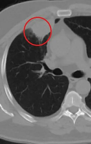 Koronavirüste şoke eden olay! Dünya literatüründe bir ilk! Koronavirüs akciğer kanserini taklit ediyor!
