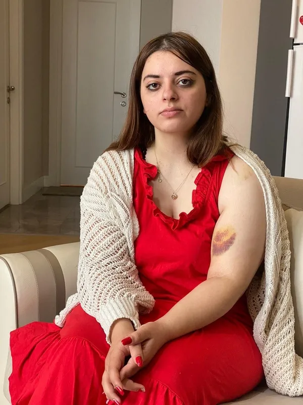 istanbul-beylikduzunde-urdunlu-kadin-eski-nisanlisi-ve-arkadasi-tarafindan-saldiriya-ugradi-saldirgan-tutuklan-1655798947212.jpg İstanbul Beylikdüzü'nde Ürdünlü kadın eski nişanlısı ve arkadaşı tarafından saldırıya uğradı saldırgan tutuklandı! 'Beni dövdüler kollarımı ısırdı'-3