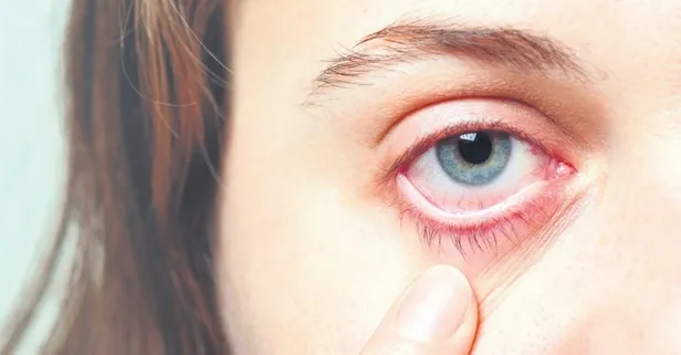 Gözde et büyümesine (Pterjium) yol açan 4 sinsi neden: Uzmanından hayati uyarılar