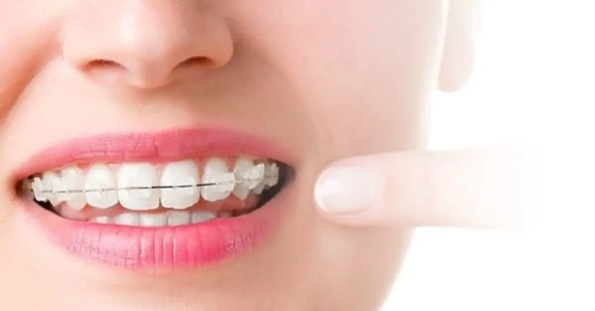 Dis Telleri Neden Takilir Ve Ne Kadar Sure Takili Kalir Cesitleri Nelerdir Iste Dis Telleri Tedavisi Hakkinda Merak Edilenler Takvim