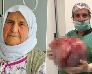 Kilo aldığını sandı, karnından 12 kiloluk kist çıktı