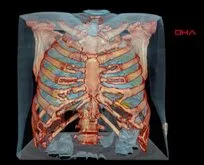 Koronalı akciğerin 3D görüntüsü