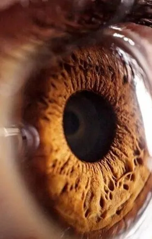 Sarı nokta hastalığı, tedavi edilmezse körlüğe neden oluyor! Sarı nokta hastalığının belirtileri nelerdir?