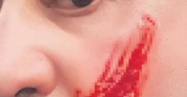 Avukat Cüneyt Şeker'in haciz işlemi sırasında ısırılarak yanağı koparıldı (Yaşam haberleri)