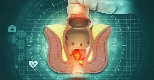 cepteki-tehlike-hemoroide-gebe-1637782323331.jpeg