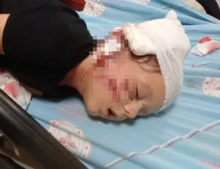 Antalya'da kulağı, kafası ve kolunu köpek ısıran küçük çocuğa 50’ye yakın dikiş atıldı