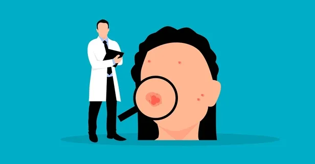 15 dakikada sivilcelere son! Uzman ilaçsız kusursuz cildin formülünü açıkladı