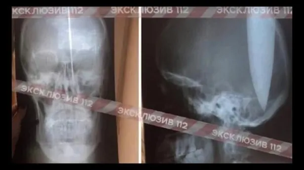 Rusya'da nefes alamayan adam kafasını deldi-2